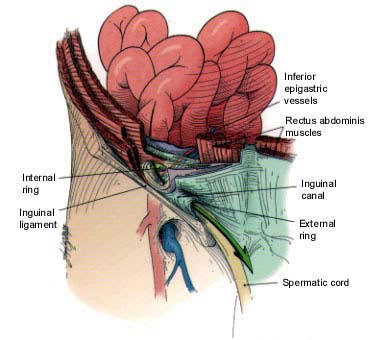 femoral-hernia.jpg